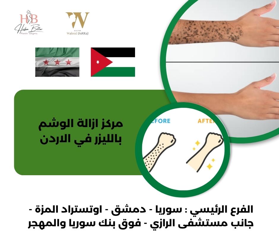 أسعار إزالة الوشم بالليزر في الاردن