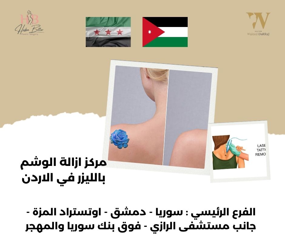 إزالة الوشم بالليزر في الاردن