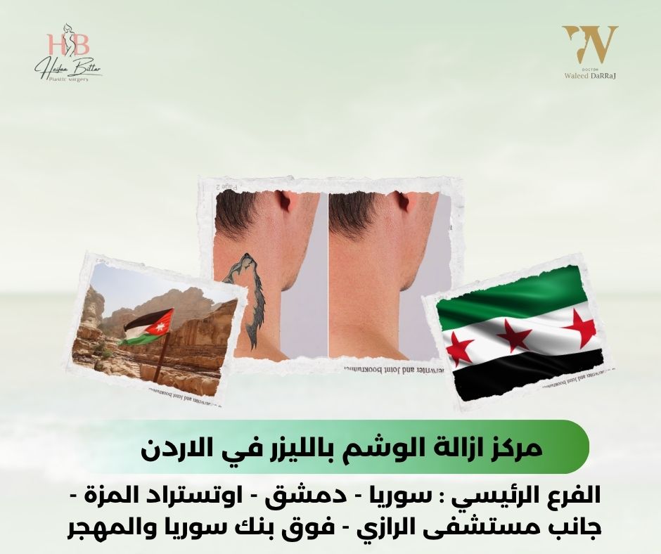 مركز ازالة الوشم بالليزر في الاردن