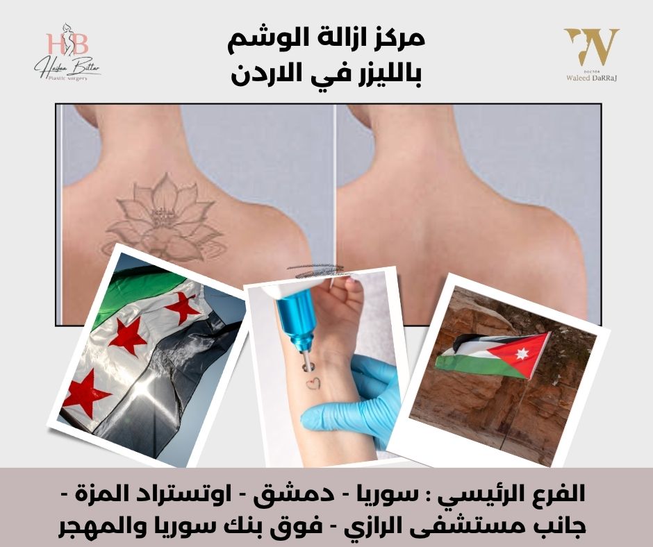 أسعار إزالة الوشم بالليزر في الأردن