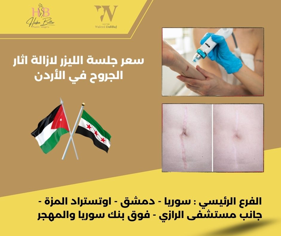 تكلفة إزالة آثار الجروح بالليزر في الأردن