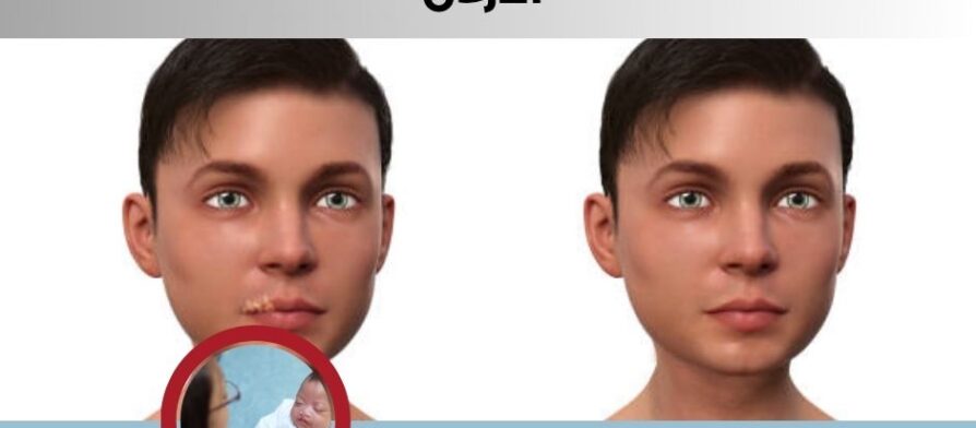 تكلفة عملية الشفة الارنبية في الاردن