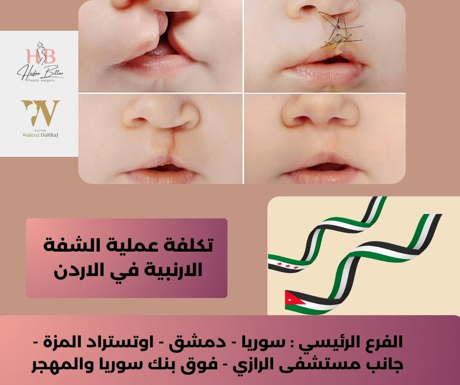 الشفة الارنبية وراثة