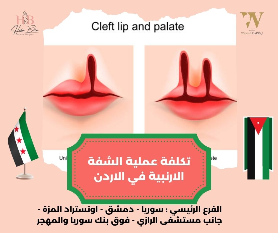 تكلفة عملية الشفة الارنبية في الاردن