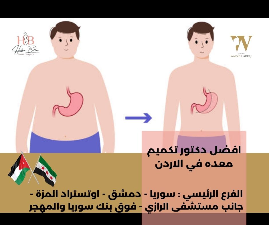 افضل طبيب تكميم في الاردن