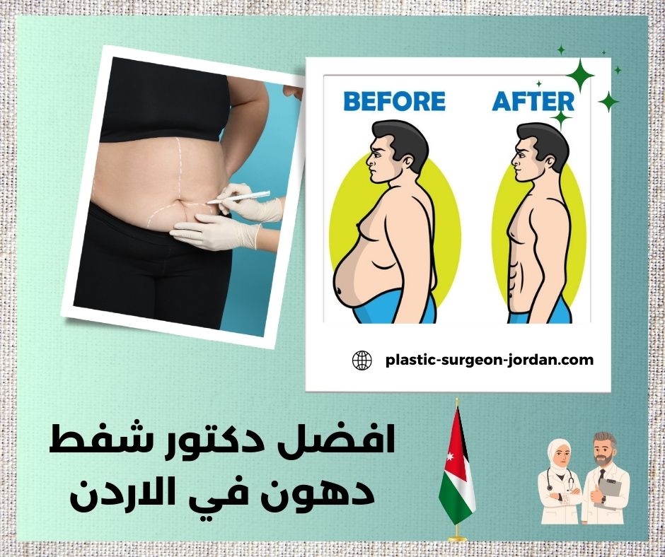 افضل دكتور شفط دهون في الامارات