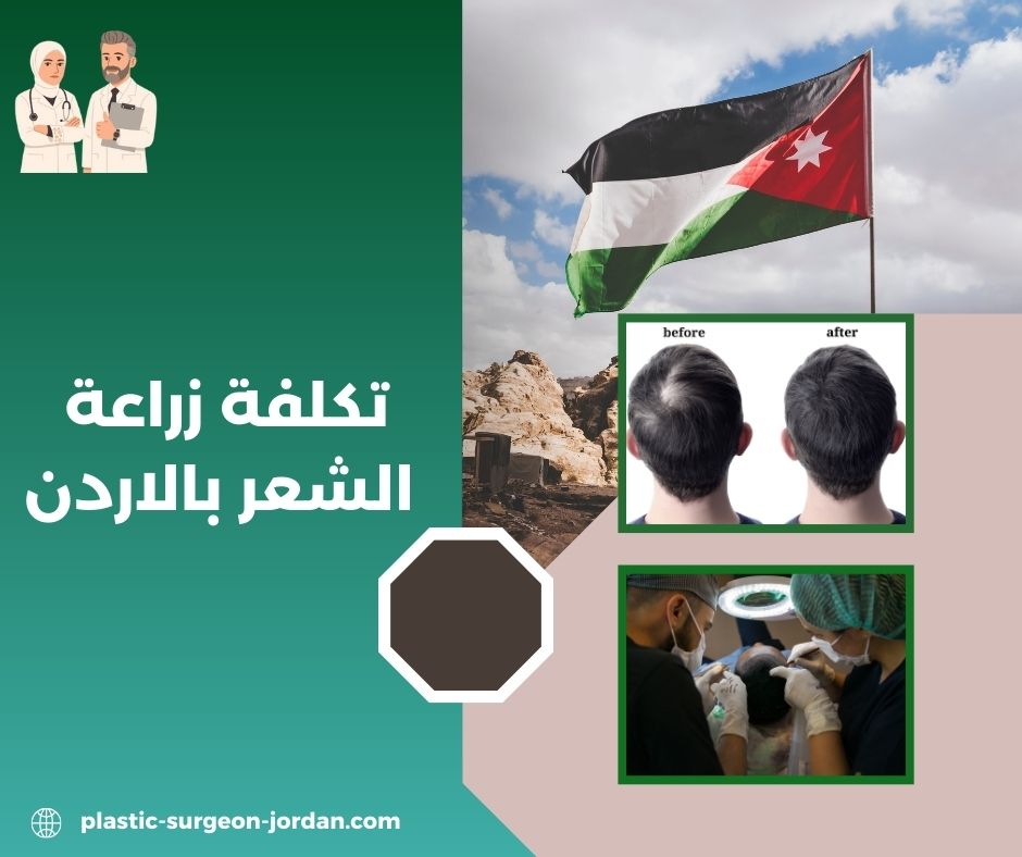 تكلفة زراعة الشعر بالاردن تكلفة زراعة الشعر بالاردن