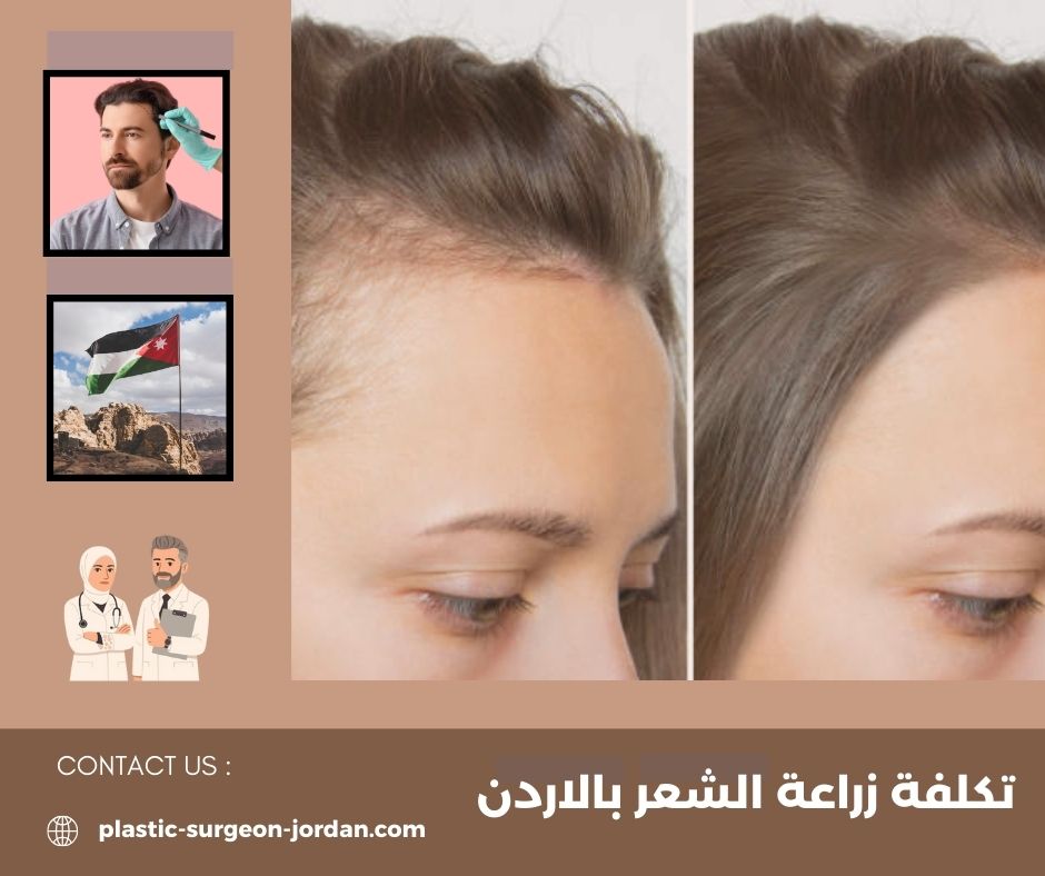 ابرة النضارة للوجه في الاردن ابرة النضارة للوجه في الاردن