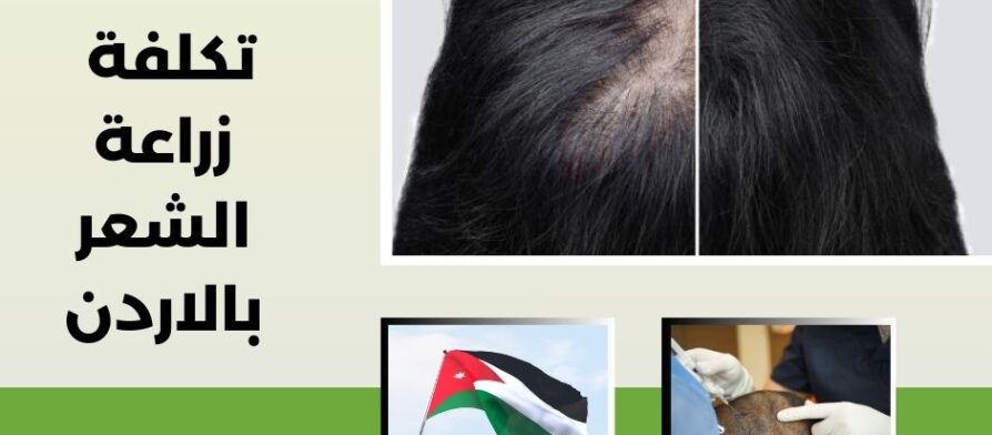 تكلفة زراعة الشعر بالاردن