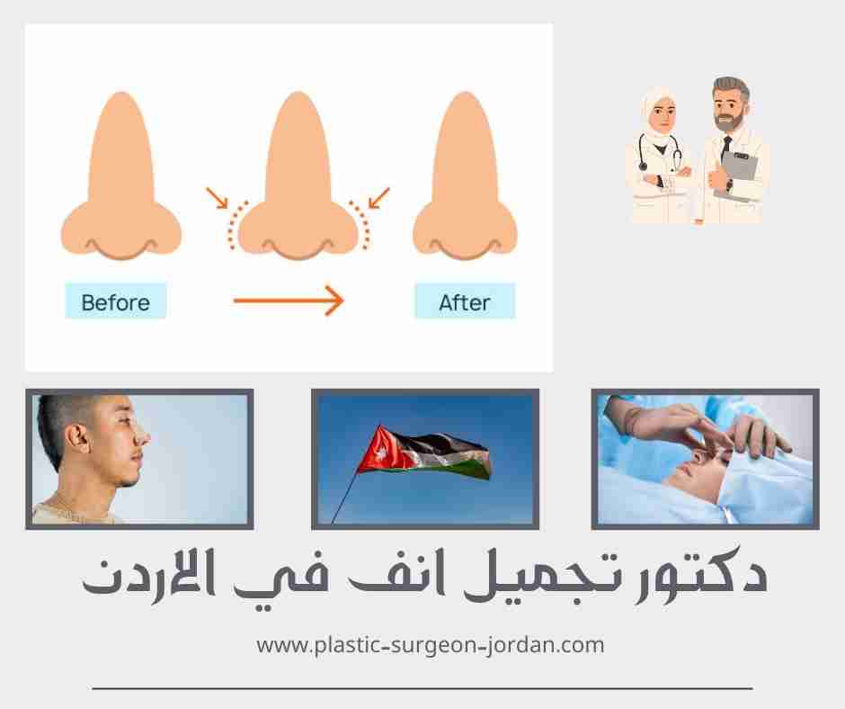 دكتور تجميل انف في الاردن