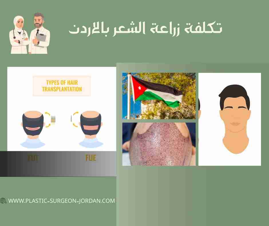 تكلفة زراعة الشعر بالاردن