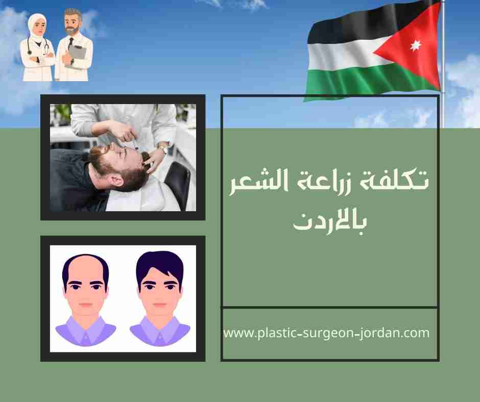 تكلفة زراعة الشعر بالاردن