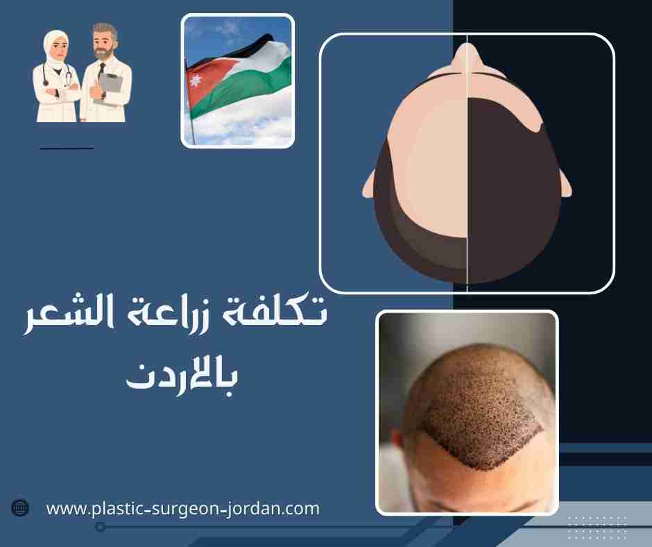 تكلفة زراعة الشعر بالاردن