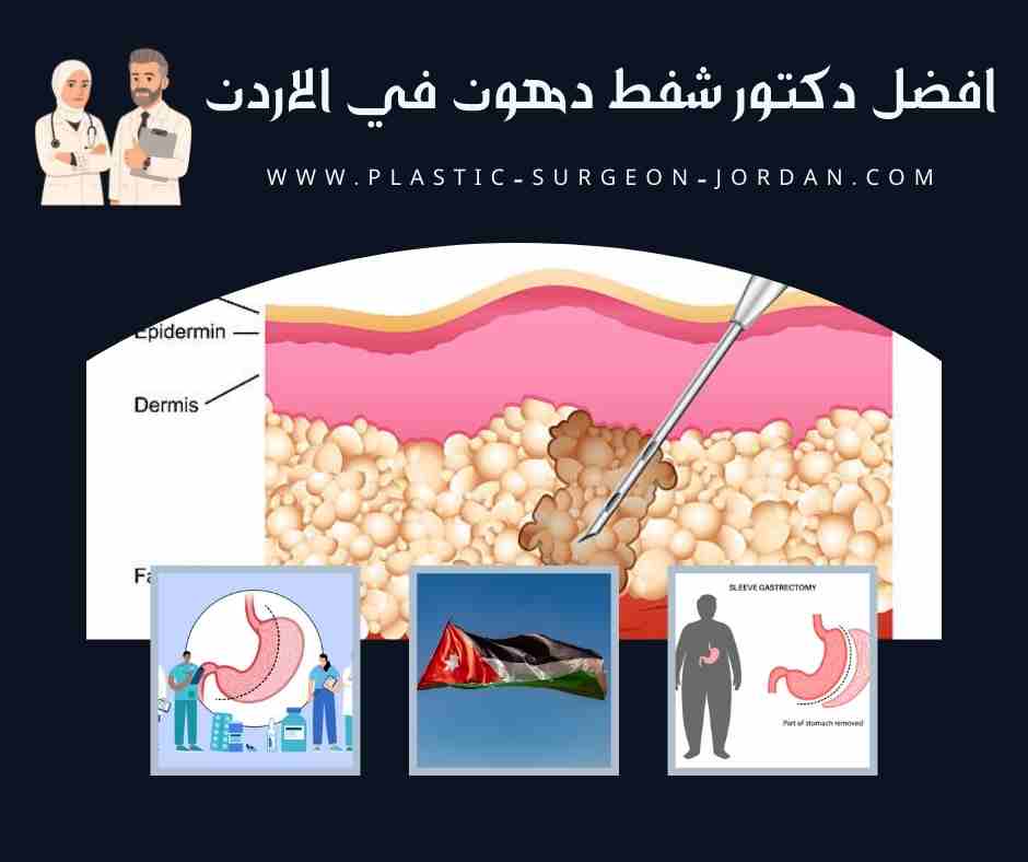 افضل دكتور شفط دهون في الاردن
