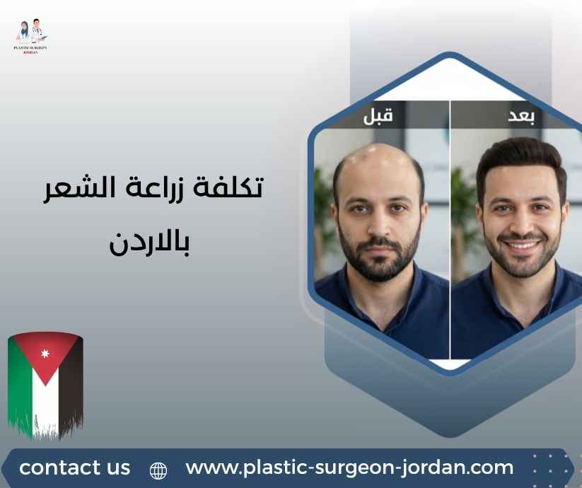 تكلفة زراعة الشعر بالاردن