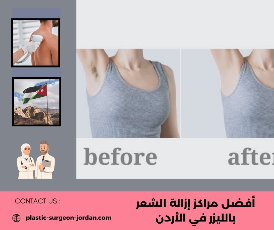 مراكز إزالة الشعر بالليزر في عمان