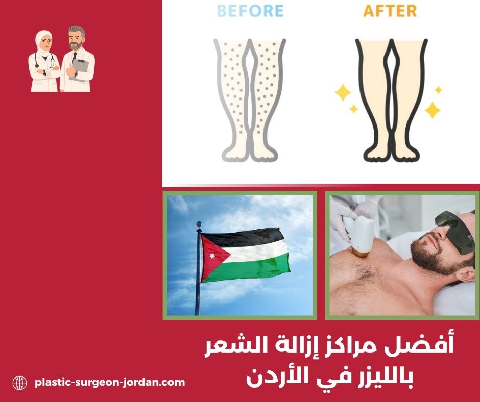 مراكز إزالة الشعر بالليزر للرجال في الاردن