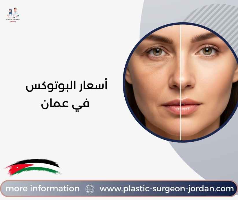 أسعار البوتوكس في عمان