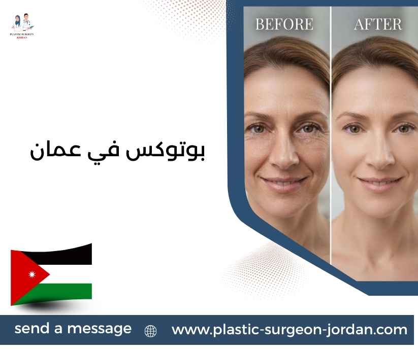 بوتوكس في عمان