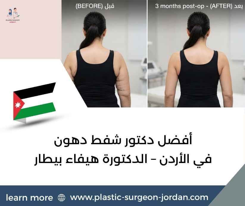 أفضل دكتور شفط دهون في الأردن – الدكتورة هيفاء بيطار