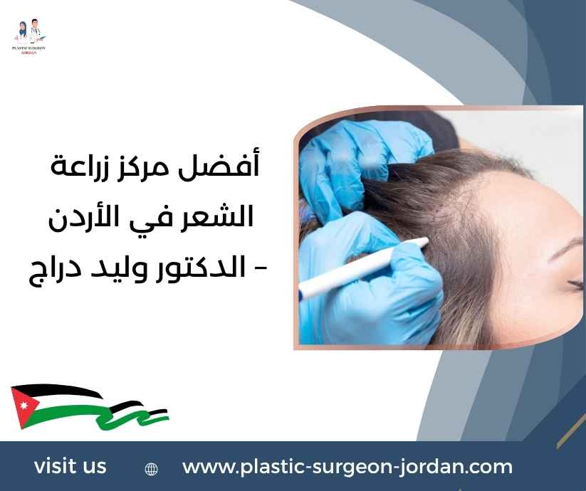 أفضل مركز زراعة الشعر في الأردن – الدكتور وليد دراج