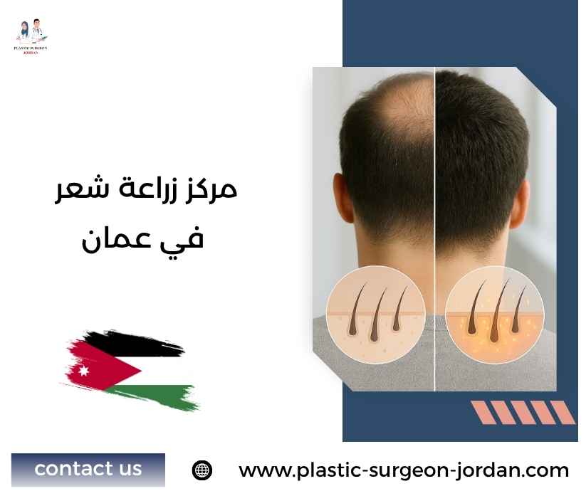 مركز زراعة شعر في عمان