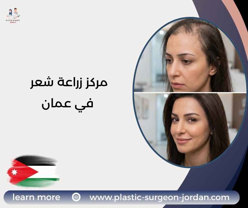 مركز زراعة شعر في عمان